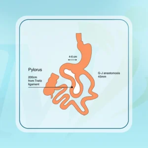 عملية الميني ساسي