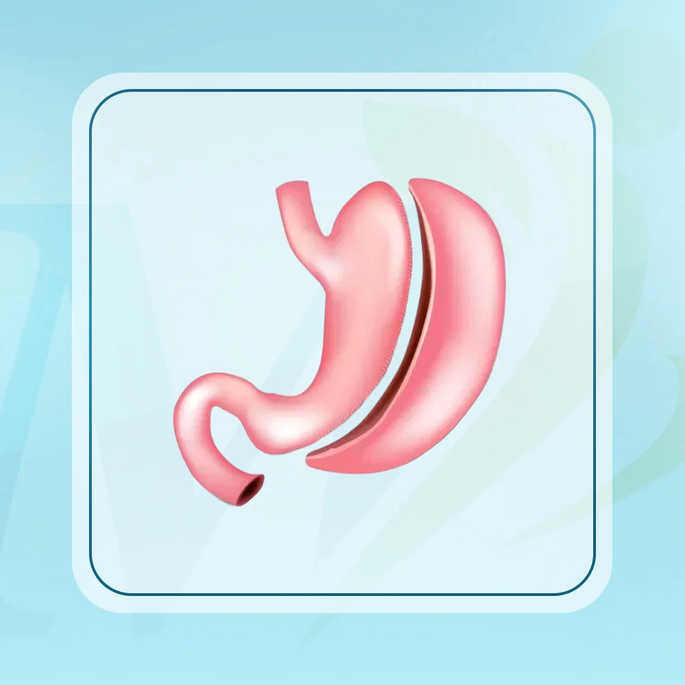 عملية تكميم المعدة