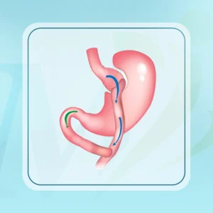 عملية تحويل المسار