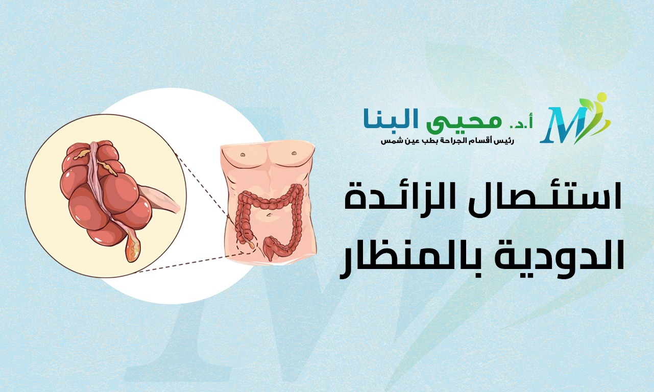 استئصال الزائدة الدودية بالمنظار