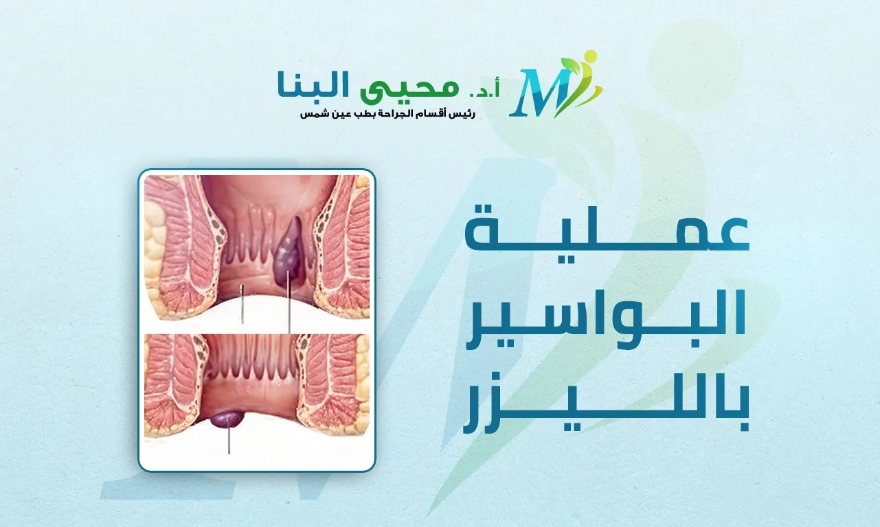 البواسير بالليزر