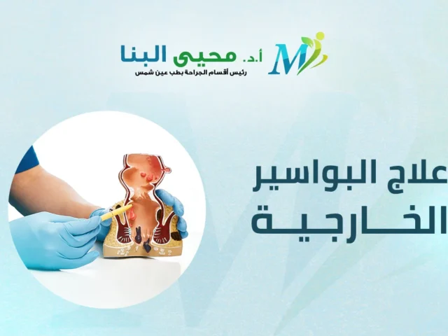علاج البواسير الخارجية: الأسباب وطرق العلاج ومدة زوال الانتفاخ