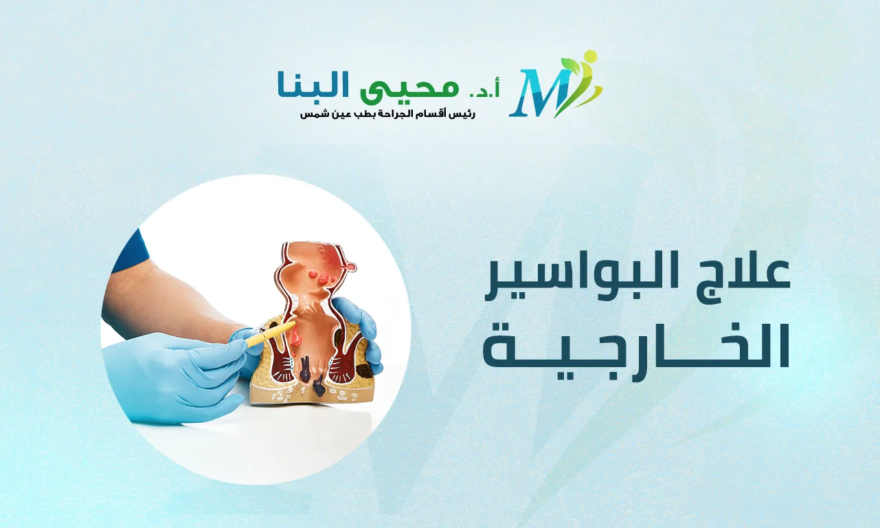 علاج البواسير الخارجية