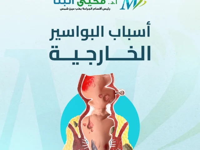 أسباب البواسير الخارجية: من أين تأتي وكيف يمكن علاجها؟