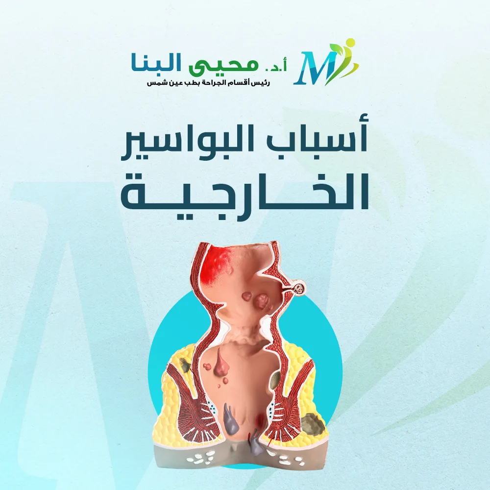 أسباب البواسير الخارجية
