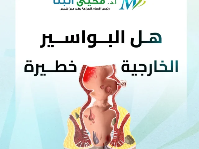 هل البواسير الخارجية خطيرة؟ وما العلامات التي تستدعي التدخل الجراحي؟