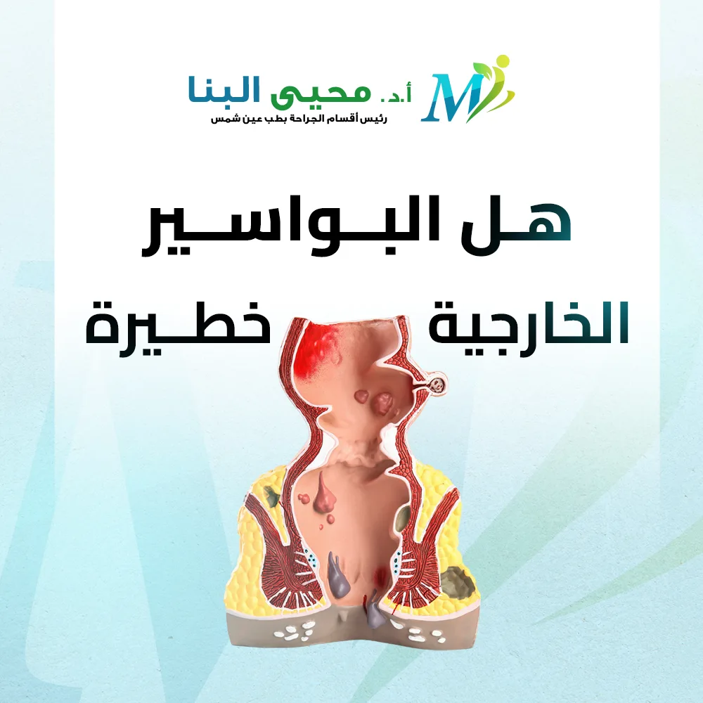 هل البواسير الخارجية خطيرة