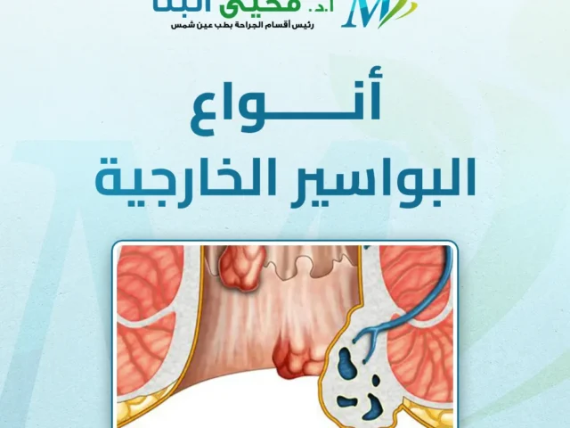 أنواع البواسير الخارجية وأعراضها ودرجاتها ومدة استمرارها
