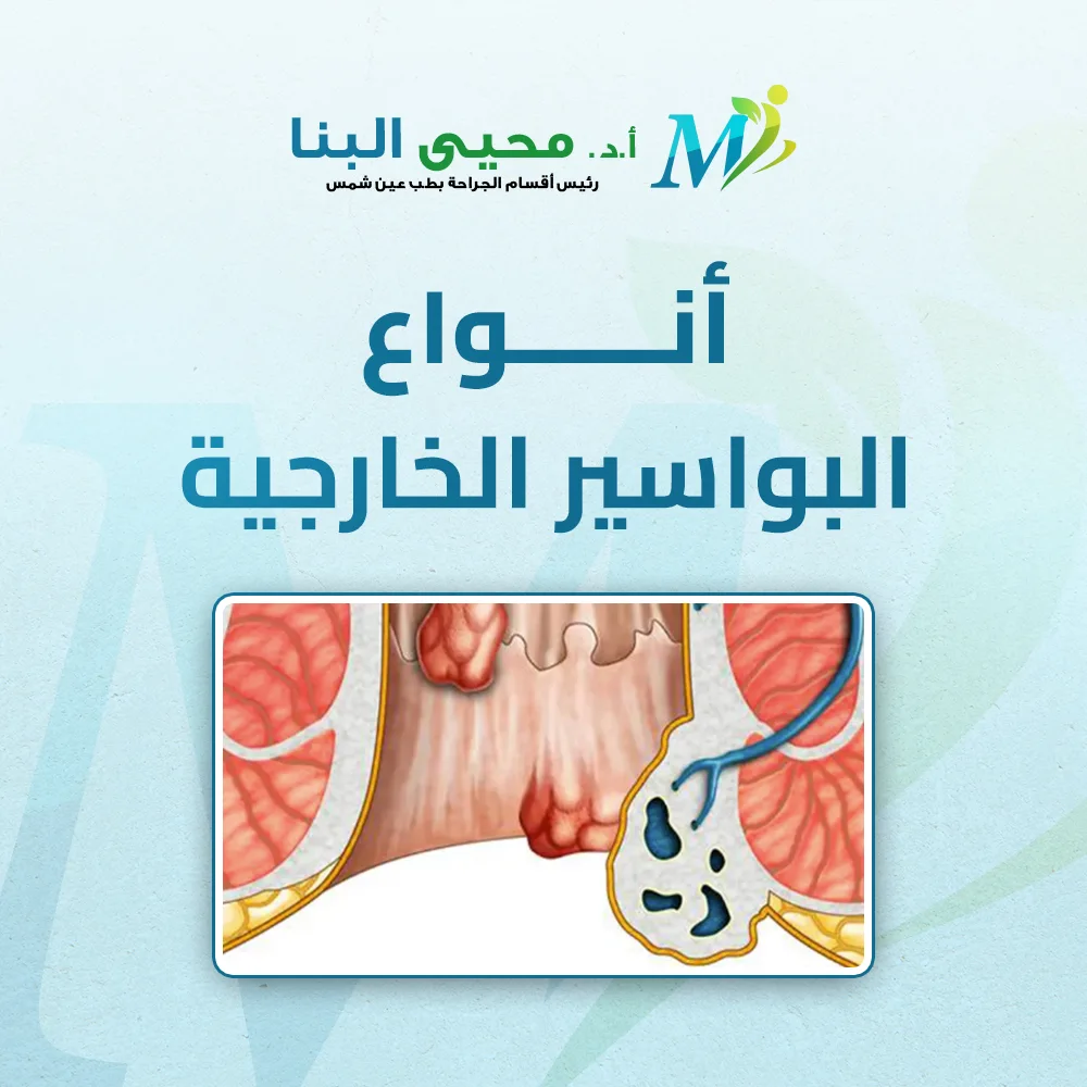 أنواع البواسير الخارجية